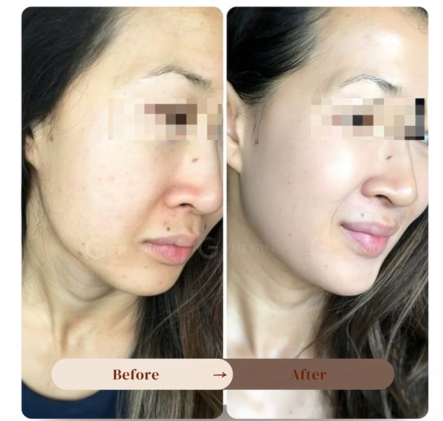 Liệu pháp peel da an toàn được chuyên gia tin tưởng, thay thế filler và botox- Ảnh 1.