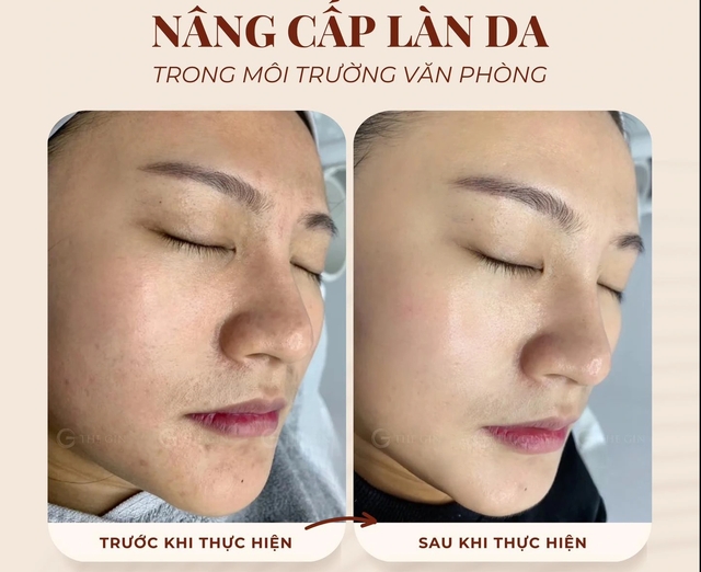 Liệu pháp peel da an toàn được chuyên gia tin tưởng, thay thế filler và botox- Ảnh 4.