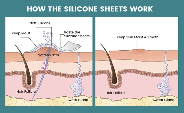 Miếng dán Silicone Y tế và Steroid trị sẹo lồi, nên dùng loại nào?- Ảnh 3.