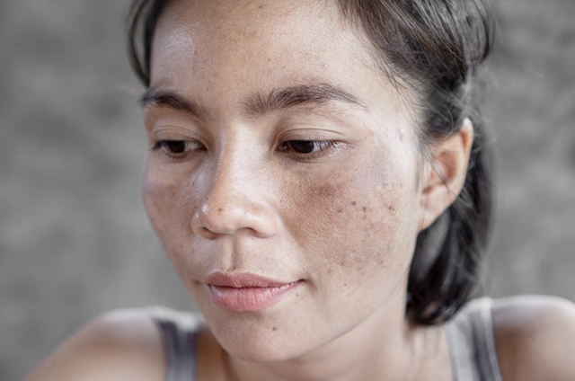 Sạm, nám lâu năm có điều trị 'dứt điểm' an toàn được không?- Ảnh 4.