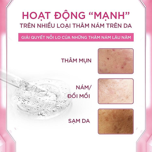 Sạm, nám lâu năm có điều trị 'dứt điểm' an toàn được không?- Ảnh 6.