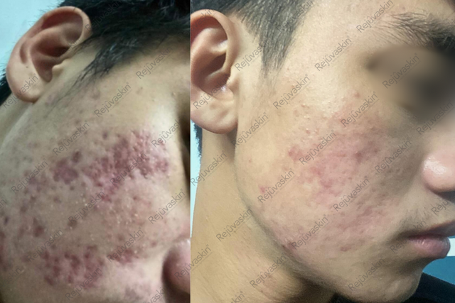 Kết quả sử dụng Scar Esthetique cho sẹo thâm lõm mụn sau 6 tháng