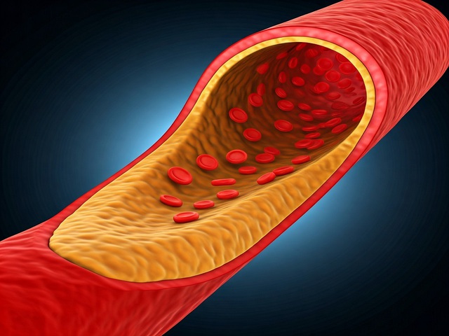 Tại sao xơ vữa động mạch được gọi là ‘kẻ giết người thầm lặng’?- Ảnh 1.