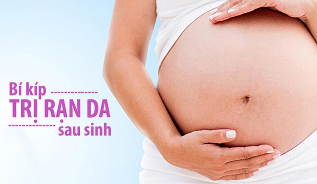 Top 5 kem trị rạn da sau sinh mẹ bỉm dùng là hết kể cả rạn trắng