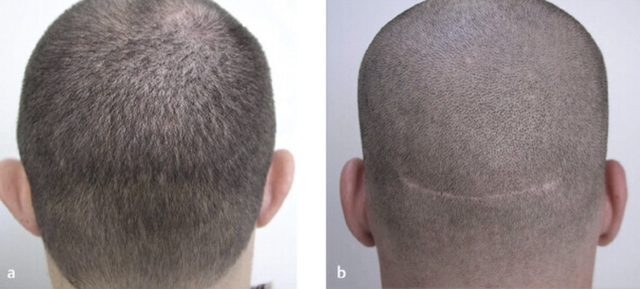 PGS-TS BS Phạm Hiếu Liêm chia sẻ phương pháp cấy tóc FUE (Follicular Unit Excision)- Ảnh 2.