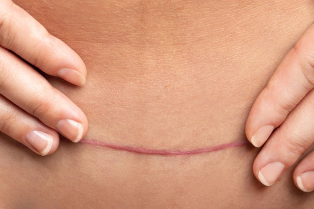 Sẹo phẫu thuật tạo thành bụng: Nguyên nhân và cách điều trị hiệu quả ngay tại nhà- Ảnh 2.