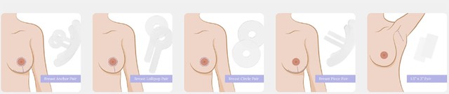 Phương pháp quản lý sẹo lồi sau phẫu thuật thẩm mỹ ngực- Ảnh 4.
