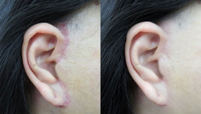 Sẹo căng da mặt: Nguyên nhân hình thành và cách điều trị sẹo hiệu quả nhanh chóng- Ảnh 1.