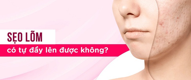 Sẹo lõm có tự đầy không? Cách trị sẹo lõm lấy lại làn da mịn màng- Ảnh 1.