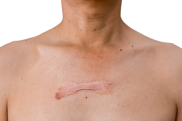 Sẹo lồi ở ngực: Nguyên nhân và cách điều trị ngay tại nhà không xâm lấn- Ảnh 3.