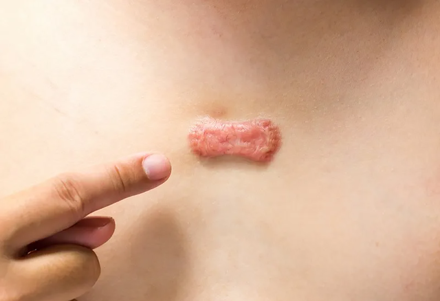 Sẹo lồi ở ngực: Nguyên nhân và cách điều trị ngay tại nhà không xâm lấn- Ảnh 4.