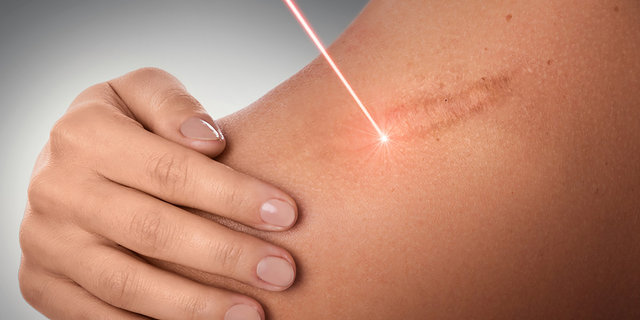 Sẹo lồi ở ngực: Nguyên nhân và cách điều trị ngay tại nhà không xâm lấn- Ảnh 6.