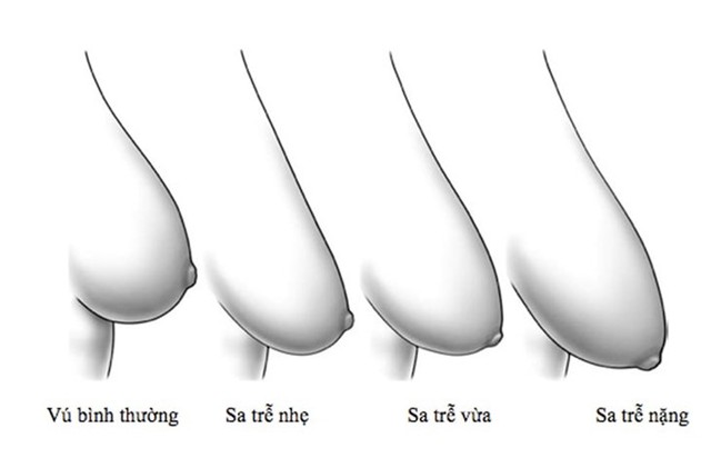 Bật mí cách ngừa sẹo treo sa trễ bằng kem trị sẹo và miếng dán tại nhà- Ảnh 3.