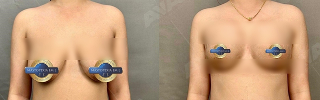Hình ảnh trước (trái) và sau (phải) của một ca treo ngực chữ L sau 1 tháng