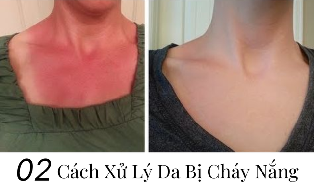 Hướng dẫn xử lý da bị cháy nắng đơn giản và nhanh chóng ngay tại nhà