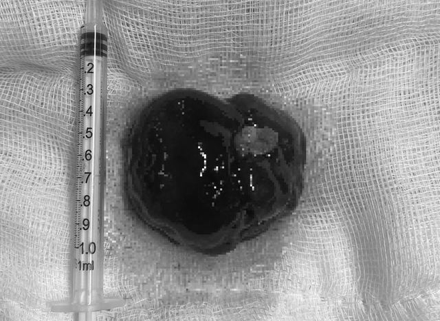 Phẫu thuật xuyên đêm cứu bệnh nhân bị khối u tim 'khổng lồ'- Ảnh 2.