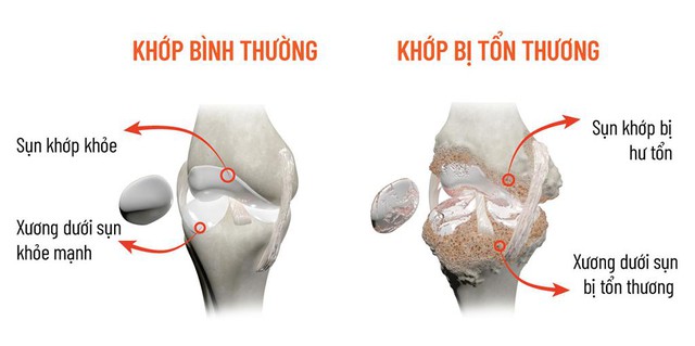 Đột phá khoa học mới giúp giảm đau xương khớp từ gốc- Ảnh 2.