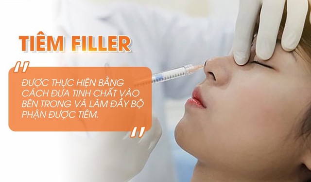 Filler đường mũi là một trong những kỹ thuật phổ biến nhất, sử dụng các chất làm đầy như hyaluronic acid để tạo hình dáng mũi mong muốn