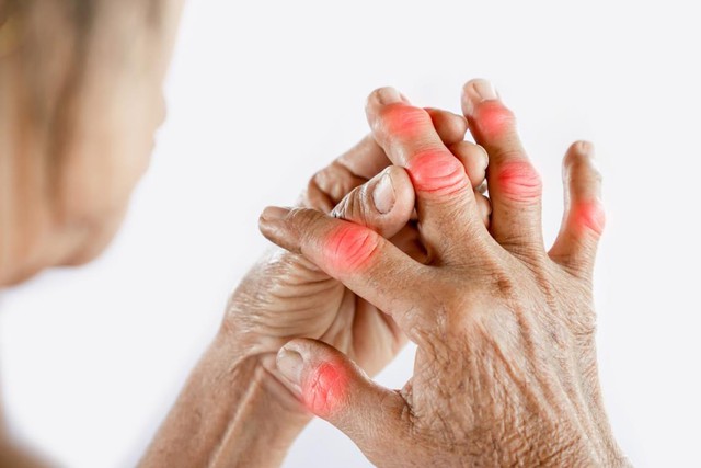 Thoái hóa khớp ngón tay nếu không điều trị sớm có thể gây đau nhiều hơn, kể cả khi người bệnh nghỉ ngơi