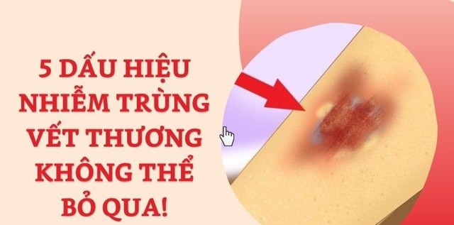 Vết thương nhiễm trùng có nguy hiểm không? Làm thế nào để ngăn ngừa biến chứng?- Ảnh 3.