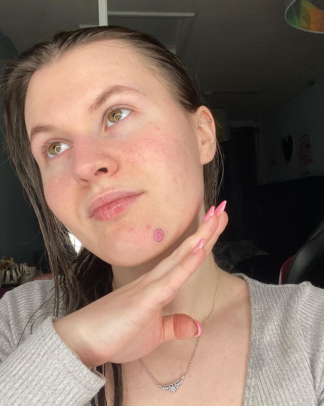 Casey Rowe, một beauty bloger sống tại Anh đăng ảnh gương mặt có dán một sicker hồng ngay dưới cằm và chia sẻ: 