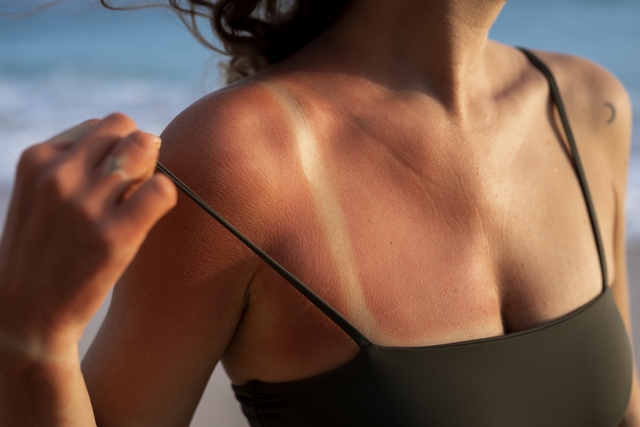 Khi bị cháy nắng, da có thể bị đỏ, đau và gây cảm giác khó chịu