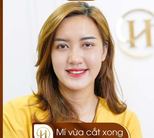 Phẫu thuật thẩm mỹ cắt mí: nếp mí vừa cắt đã vô cùng tự nhiên hài hòa cân đối, ánh nhìn vì thế cũng tự tin hơn rất nhiều, mí sau khi cắt không hề sưng đau