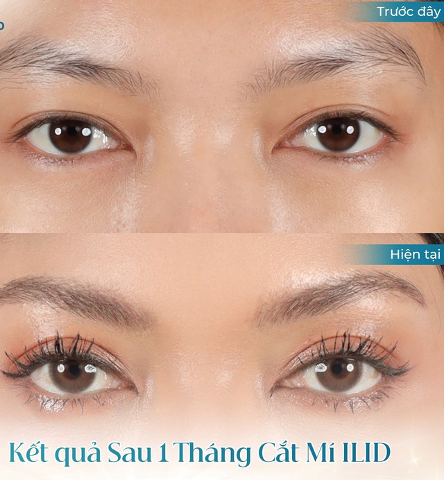 Kết quả đôi mắt sau một tháng phẫu thuật thẩm mỹ tạo hình mắt hai mí ILID