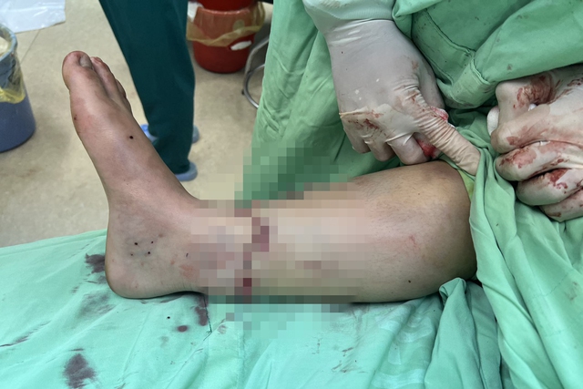 Phẫu thuật 5 tiếng đồng hồ nối bàn chân bị đứt rời cho nữ bệnh nhân- Ảnh 1.