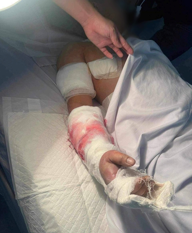Sau khi được chuyển tới cấp cứu, điều trị tại Bệnh viện TƯ Quân đội 108, cánh tay bị chém lìa của anh T. đã được các bác sĩ ghép nối thành công