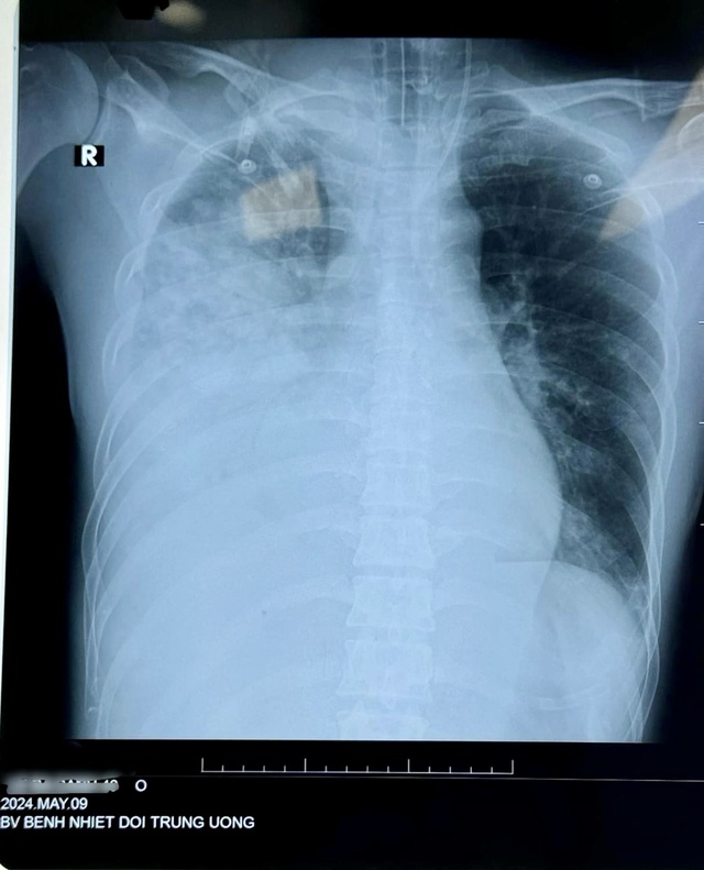 Hình ảnh viêm phổi ở bệnh nhân nhiễm cúm B
