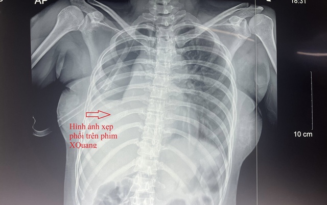Kết quả chụp X-quang ngực cho thấy bệnh nhân bị xẹp phổi, tràn khí màng phổi...