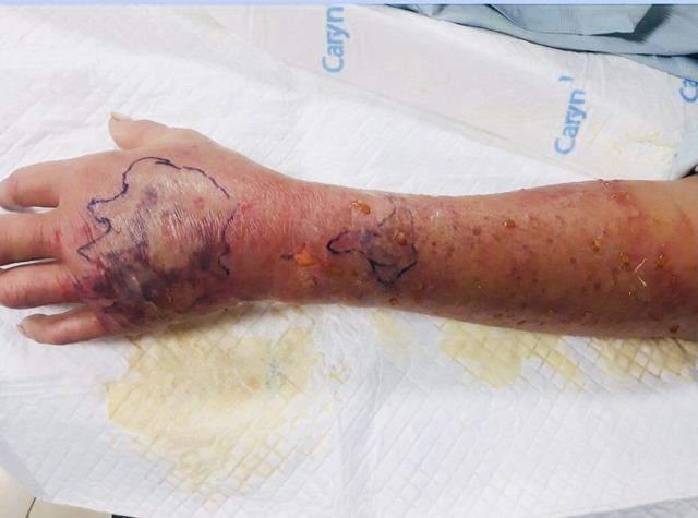 Một ngày sau khi bị cắn, nam bệnh nhân sốt 39,5 độ C, cẳng tay có vết cắn sưng đỏ
