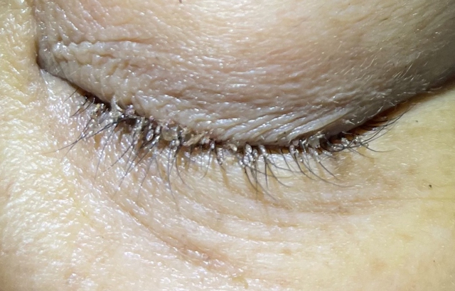 Rận ký sinh, đẻ trứng trên mi mắt bệnh nhân- Ảnh 1.