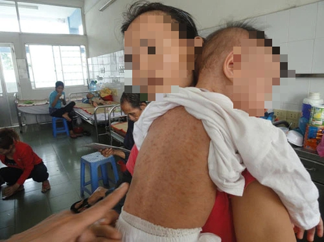 Phát hiện 2 trẻ ở TP.HCM mắc bệnh sởi vì chưa được tiêm vắc xin- Ảnh 1.