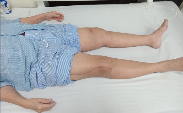 Một trong 3 nạn nhân trong vụ tai nạn lao động đang được điều trị tại bệnh viện ở Hà Nội