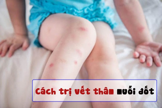 Top 5 kem trị sẹo thâm do côn trùng cắn được tìm mua nhiều hiện nay- Ảnh 1.