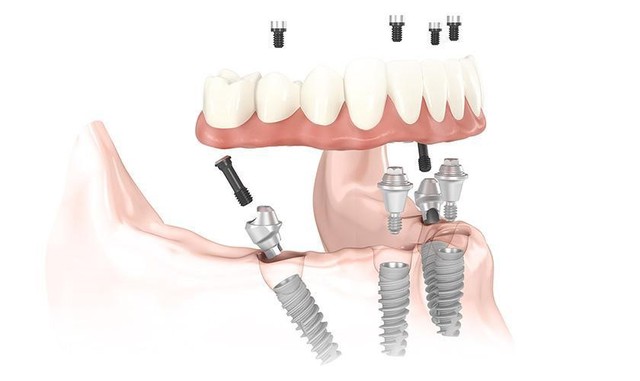 Trồng răng Implant toàn hàm, nâng cao sức khỏe, nâng cao chất lượng cuộc sống- Ảnh 1.