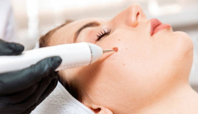 Cách chăm sóc vết thương sau điều trị laser nốt ruồi để ngăn ngừa sẹo- Ảnh 1. Cách chăm sóc vết thương sau điều trị laser nốt ruồi để ngăn ngừa sẹo- Ảnh 1.
