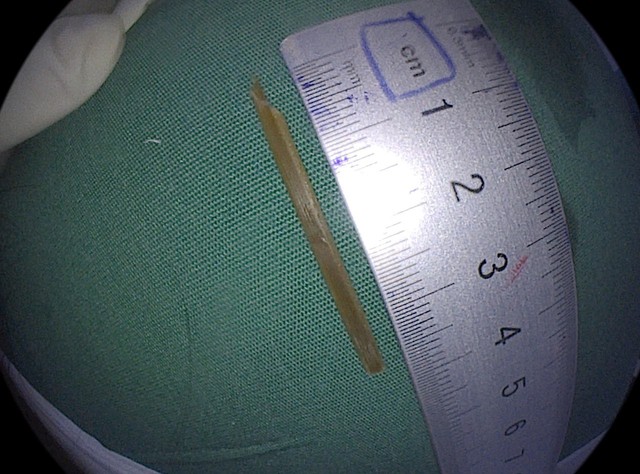 Gắp nhánh sả dài 3,5 cm ra khỏi dạ dày người phụ nữ- Ảnh 1.