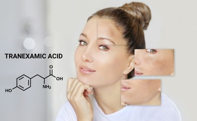 Tranexamic Acid là gì? Tác dụng với làn da và top 3 sản phẩm hiệu quả- Ảnh 1.