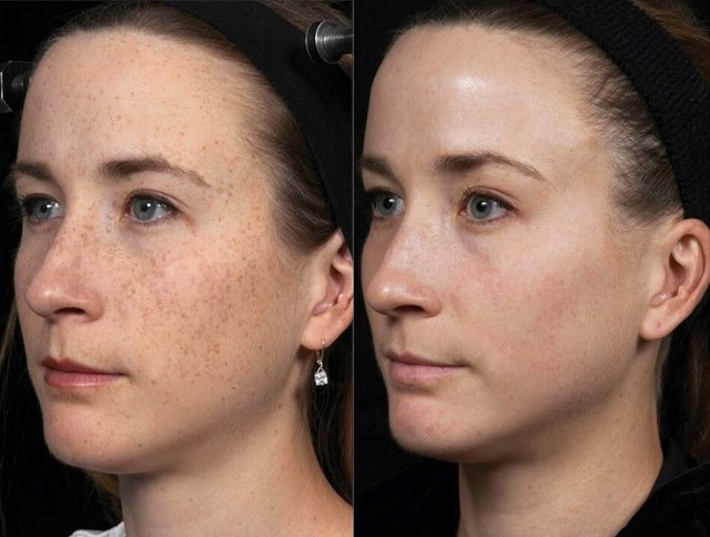 Review serum trị nám Image Iluma Intense Facial Illuminator có hiệu quả không?- Ảnh 3.