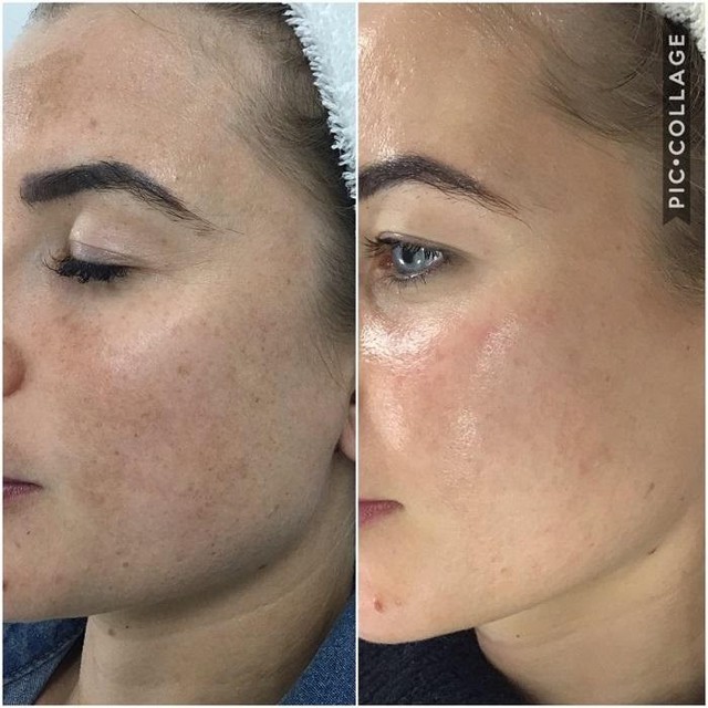 Review serum trị nám Image Iluma Intense Facial Illuminator có hiệu quả không?- Ảnh 8.