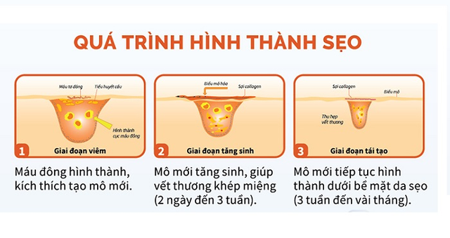 Sẹo mổ đẻ, dùng kem trị sẹo có hết không? - Ảnh 2.