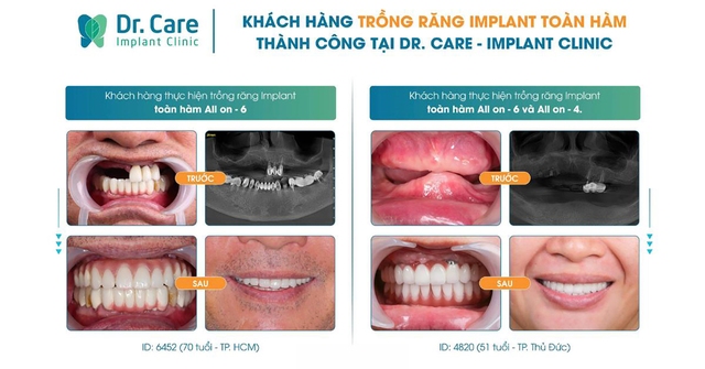 Dr. Care - Implant Clinic: trồng răng Implant tại TP.HCM chất lượng cho người trung niên- Ảnh 5.