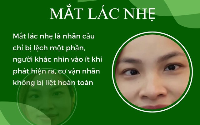 Mắt lác (lé) nhẹ: Triệu chứng, nguyên nhân, phương pháp điều trị- Ảnh 1.