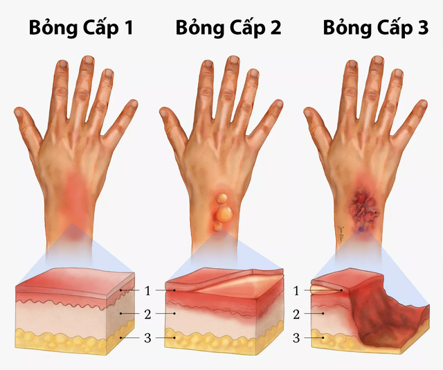 Bị bỏng nên làm gì để không bị sẹo xấu?- Ảnh 2.