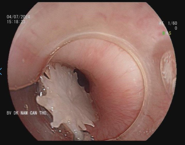 Bị hóc xương cá nguy kịch vì vừa ăn vừa nói chuyện- Ảnh 1.