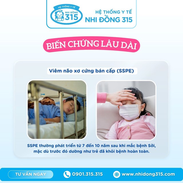 Cần biết những biến chứng nguy hiểm của bệnh sởi- Ảnh 3.