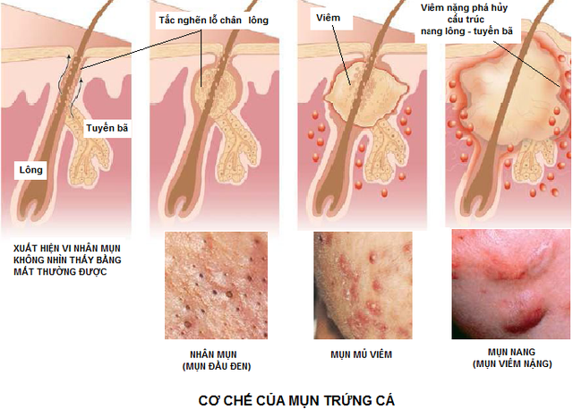 Chăm sóc da mụn thế nào để tránh tái phát?- Ảnh 2.